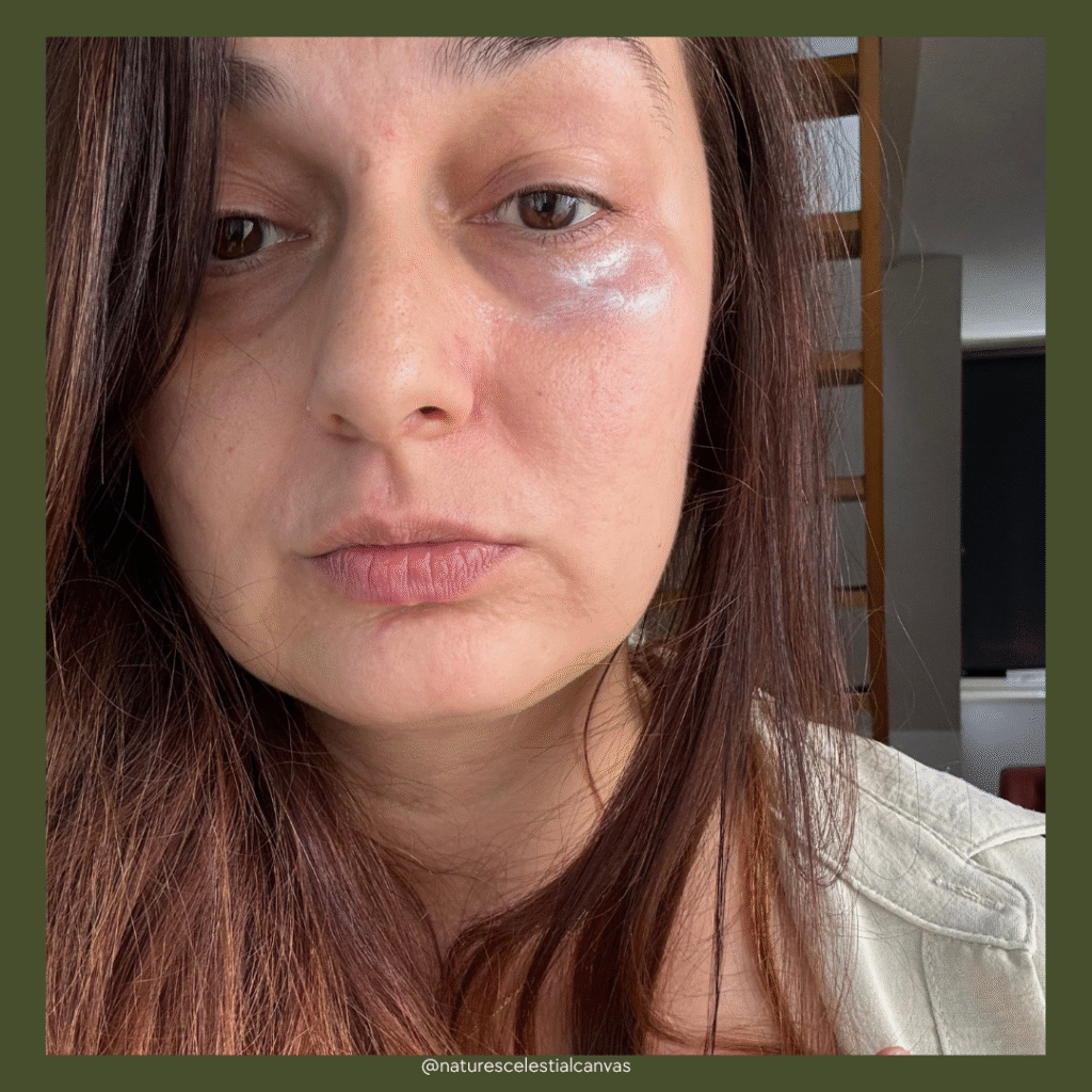 before and after How Do I Get Rid of My Dark Under Eye Circles?